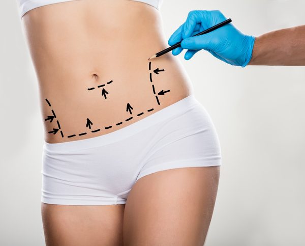 Close-up Of A Surgeon Drawing Correction Lines On Woman's Stomach